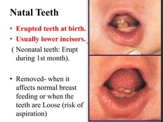 Natal Teeth
• Erupted teeth at birth.
• Usually lower incisors.
( Neonatal teeth: Erupt
during 1st month).
• Removed- when it
affects normal breast
feeding or when the
teeth are Loose (risk of
aspiration)
 