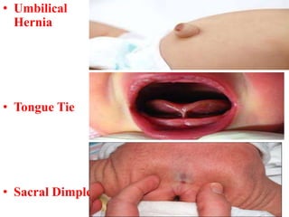 • Umbilical
Hernia
• Tongue Tie
• Sacral Dimple
 