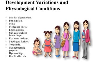 Development Variations and
Physiological Conditions
• Mastitis Neonatorum.
• Peeling skin.
• Milia.
• Mongolian spots.
• Epstein pearls.
• Sub-conjunctival
hemorrhage.
• Erythema toxicum.
• Sucking callosities.
• Tongue tie.
• Non retractable
prepuce.
• Hymenal tags.
• Umblical hernia
 