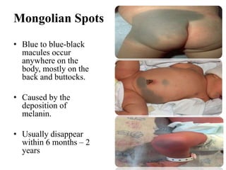 Mongolian Spots
• Blue to blue-black
macules occur
anywhere on the
body, mostly on the
back and buttocks.
• Caused by the
deposition of
melanin.
• Usually disappear
within 6 months – 2
years
 
