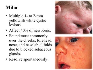 Milia
• Multiple 1- to 2-mm
yellowish white cystic
lesions.
• Affect 40% of newborns.
• Found most commonly
over the cheeks, forehead,
nose, and nasolabial folds
due to blocked sebaceous
glands.
• Resolve spontaneously
 