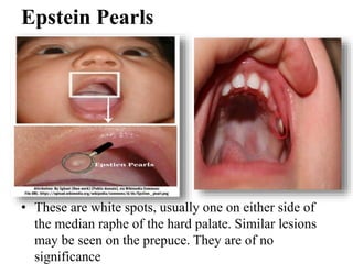 Epstein Pearls
• These are white spots, usually one on either side of
the median raphe of the hard palate. Similar lesions
may be seen on the prepuce. They are of no
significance
 