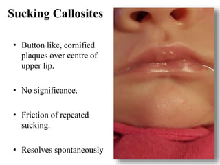 Sucking Callosites
• Button like, cornified
plaques over centre of
upper lip.
• No significance.
• Friction of repeated
sucking.
• Resolves spontaneously
 