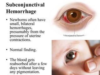 Subconjunctival
Hemorrhage
• Newborns often have
small, bilateral
hemorrhages,
presumably from the
pressure of uterine
contractions.
• Normal finding.
• The blood gets
reabsorbed after a few
days without leaving
any pigmentation.
 