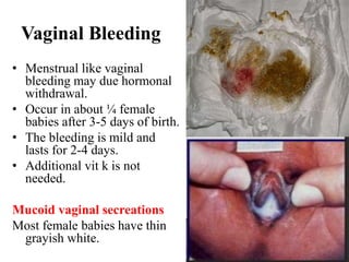 Vaginal Bleeding
• Menstrual like vaginal
bleeding may due hormonal
withdrawal.
• Occur in about ¼ female
babies after 3-5 days of birth.
• The bleeding is mild and
lasts for 2-4 days.
• Additional vit k is not
needed.
Mucoid vaginal secreations
Most female babies have thin
grayish white.
 