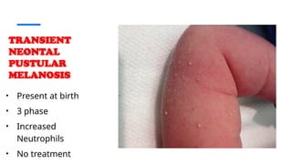 COMMON NEWBORN DERMATOSES . p p t x | PPTX