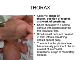 NEWBORN EXAMINATION in pediatrics and obgy | PPTX
