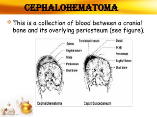 Cephalohematoma
 This is a collection of blood between a cranial
bone and its overlying periosteum (see figure).
 