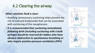 4.2 Clearing the airway
When amniotic fluid is clear:
• Avoiding unnecessary suctioning helps prevent the
risk of induced bradycardia that can be associated
with suctioning of the nasopharynx.
• It is recommended that suctioning immediately
following birth (including suctioning with a bulb
syringe) should be reserved for babies who have
obvious obstruction to spontaneous breathing or
who require positive-pressure ventilation (PPV)
 