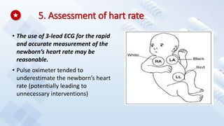 5. Assessment of hart rate
• The use of 3-lead ECG for the rapid
and accurate measurement of the
newborn’s heart rate may be
reasonable.
• Pulse oximeter tended to
underestimate the newborn’s heart
rate (potentially leading to
unnecessary interventions)
 