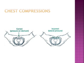 When to stop chest compressions?
 Reassess after 45-60 sec, if HR > 60/min stop
chest compressions and increase breaths t...