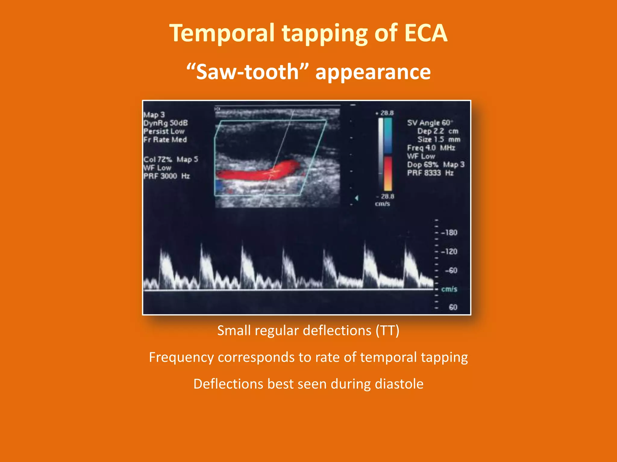New carotid doppler ultrasound | PPTX