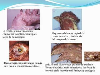 La cresta está marcadamente edematosa y contiene múltiples focos de hemorragia.Hay marcada hemorragia de la cresta y cabeza, con cianosis del margen de la cresta.Hemorragia conjuntival que es más severa en la membrana nictitante.cavidad oral. Numerosos grumos de exudado fibrino-necrótico están adheridos a los focos de necrosis en la mucosa oral, faríngea y esofágica.