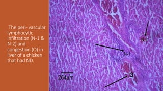 The peri- vascular
lymphocytic
infiltration (N-1 &
N-2) and
congestion (O) in
liver of a chicken
that had ND.
 