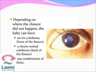 Depending on
where the closure
did not happen, the
baby can have
 an iris coloboma
(front of the fissure)
 a chorio-retinal
coloboma (back of
the fissure)
 any combination of
these.
 