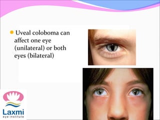 Uveal coloboma can
affect one eye
(unilateral) or both
eyes (bilateral)
 