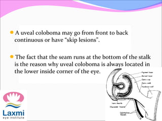 A uveal coloboma may go from front to back
continuous or have “skip lesions”.
The fact that the seam runs at the bottom of the stalk
is the reason why uveal coloboma is always located in
the lower inside corner of the eye.
 