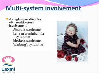 Multi-system involvement
A single-gene disorder
with multisystem
involvement
Aicardi's syndrome
Lenz microphthalmia
syndrome
Meckel's syndrome
Warburg's syndrome
 