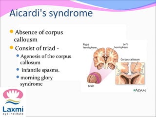 Aicardi's syndrome
Absence of corpus
callousm
Consist of triad -
Agenesis of the corpus
callosum
 infantile spasms.
morning glory
syndrome
 
