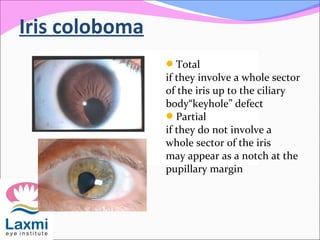 Iris coloboma
Total
if they involve a whole sector
of the iris up to the ciliary
body“keyhole” defect
Partial
if they do not involve a
whole sector of the iris
may appear as a notch at the
pupillary margin
 