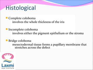 Histological
Complete coloboma
involves the whole thickness of the iris
Incomplete coloboma
involves either the pigment epithelium or the stroma
Bridge coloboma
mesectodermal tissue forms a pupillary membrane that
stretches across the defect
 