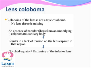 Lens coloboma
Coloboma of the lens is not a true coloboma.
No lens tissue is missing
An absence of zonular fibers from an underlying
colobomatous ciliary body
Results in a lack of tension on the lens capsule in
that region
Notched equator/ Flattening of the inferior lens
 