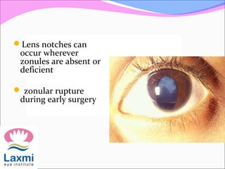 Lens notches can
occur wherever
zonules are absent or
deficient
 zonular rupture
during early surgery
 
