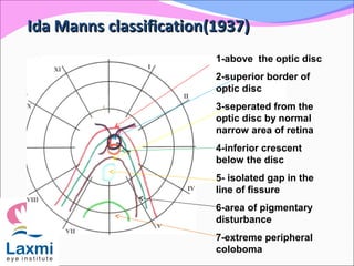 Ida Manns classification(1937)Ida Manns classification(1937)
1-above the optic disc
2-superior border of
optic disc
3-seperated from the
optic disc by normal
narrow area of retina
4-inferior crescent
below the disc
5- isolated gap in the
line of fissure
6-area of pigmentary
disturbance
7-extreme peripheral
coloboma
 