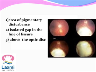 1)area of pigmentary
disturbance
2) isolated gap in the
line of fissure
3) above the optic disc
 
