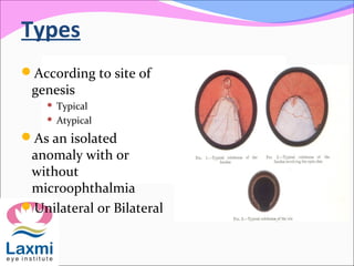 Types
According to site of
genesis
 Typical
 Atypical
As an isolated
anomaly with or
without
microophthalmia
Unilateral or Bilateral
 