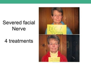Severed facial
Nerve
4 treatments
 
