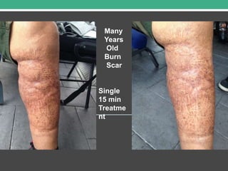 Many
Years
Old
Burn
Scar
Single
15 min
Treatme
nt
 