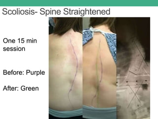 Scoliosis- Spine Straightened
One 15 min
session
Before: Purple
After: Green
 