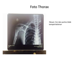 Foto Thorax 
•Kesan: Cor dan pulmo tidak 
tampak kelainan 
 