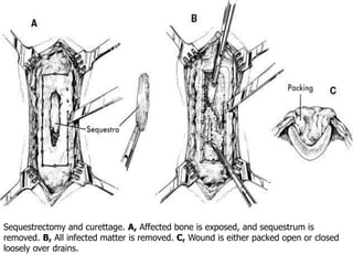 Sequestrectomy and curettage. A, Affected bone is exposed, and sequestrum is 
removed. B, All infected matter is removed. C, Wound is either packed open or closed 
loosely over drains. 
 
