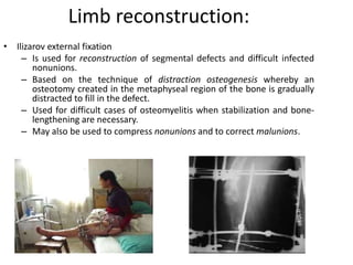 Limb reconstruction: 
• Ilizarov external fixation 
– Is used for reconstruction of segmental defects and difficult infected 
nonunions. 
– Based on the technique of distraction osteogenesis whereby an 
osteotomy created in the metaphyseal region of the bone is gradually 
distracted to fill in the defect. 
– Used for difficult cases of osteomyelitis when stabilization and bone-lengthening 
are necessary. 
– May also be used to compress nonunions and to correct malunions. 
 