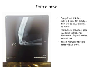 • Tampak lesi litik dan 
sklerotik pada 1/3 distal os 
humerus dan 1/3 proximal 
os radius. 
• Tampak lesi periosteal pada 
1/3 distal os humerus 
kanan dan 1/3 proksimal os 
radius kanan 
• Kesan: menyokong suatu 
osteomielitis kronis 
Foto elbow 
 
