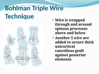 Bohlman Triple Wire
Technique  Wire is wrapped
through and around
spinous processes
above and below
 Another 2 wire are
added to secure thick
unicortical
cancellous graft
against posterior
elements
 