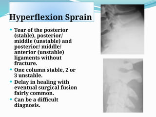 Hyperflexion Sprain
 Tear of the posterior
(stable), posterior/
middle (unstable) and
posterior/ middle/
anterior (unstable)
ligaments without
fracture.
 One column stable, 2 or
3 unstable.
 Delay in healing with
eventual surgical fusion
fairly common.
 Can be a difficult
diagnosis.
 
