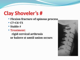 Clay Shoveler’s #
 Flexion fracture of spinous process
 C7>C6>T1
 Stable #
 Treatment:
rigid cervical arthrosis
or halove st umtil union occurs
 