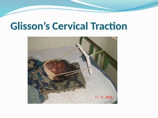 Glisson’s Cervical Traction
 