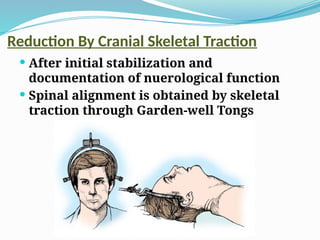 Reduction By Cranial Skeletal Traction
 After initial stabilization and
documentation of nuerological function
 Spinal alignment is obtained by skeletal
traction through Garden-well Tongs
 