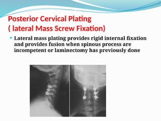 Posterior Cervical Plating
( lateral Mass Screw Fixation)
 Lateral mass plating provides rigid internal fixation
and provides fusion when spinous process are
incompetent or laminectomy has previously done
 