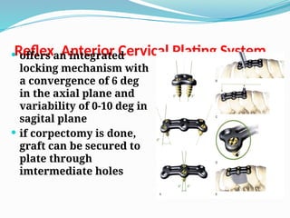 Reflex Anterior Cervical Plating System
 offers an integrated
locking mechanism with
a convergence of 6 deg
in the axial plane and
variability of 0-10 deg in
sagital plane
 if corpectomy is done,
graft can be secured to
plate through
imtermediate holes
 