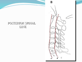 POSTERIOR SPINAL
LINE
 