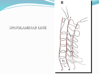 SPINOLAMINAR LINE
 