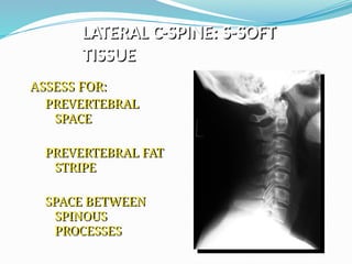 LATERAL C-SPINE: S-SOFT
TISSUE
ASSESS FOR:
PREVERTEBRAL
SPACE
PREVERTEBRAL FAT
STRIPE
SPACE BETWEEN
SPINOUS
PROCESSES
 