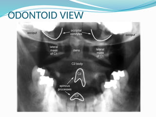 ODONTOID VIEW
 