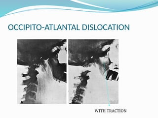 OCCIPITO-ATLANTAL DISLOCATION
WITH TRACTION
 