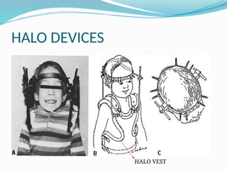 HALO DEVICES
HALO VEST
 